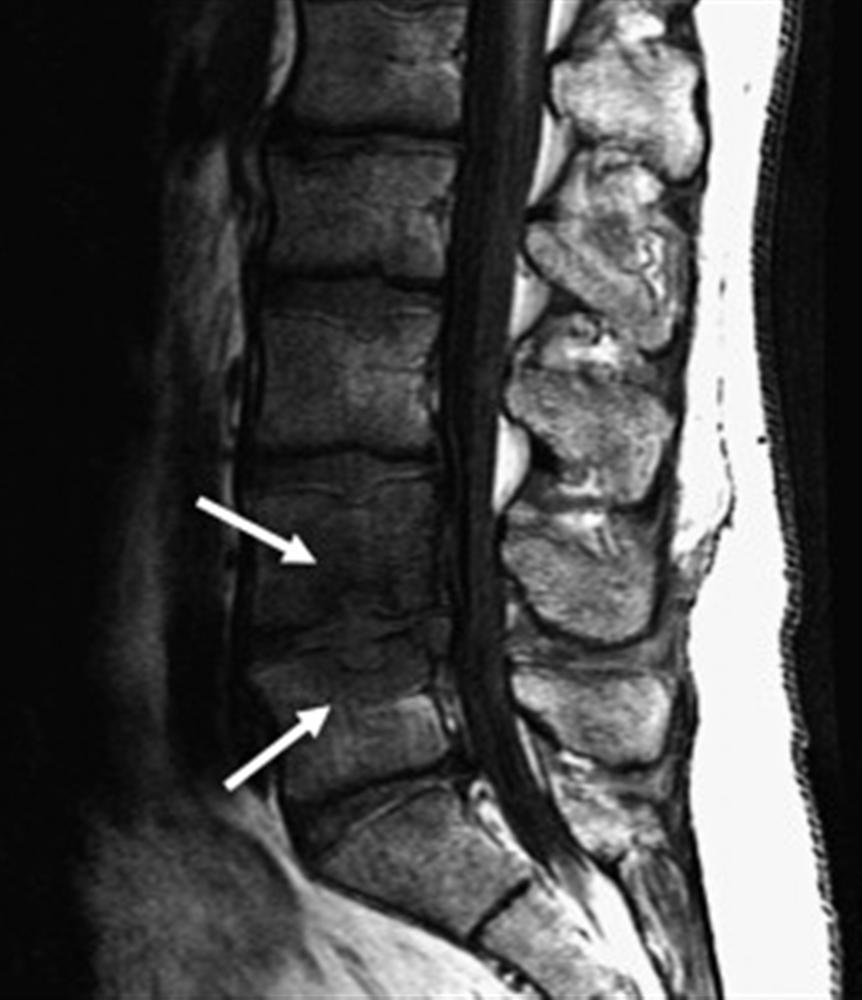 Lumbar Spinal Stenosis Spine Orthobullets